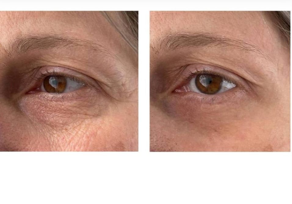 Peptilux - Anti-wrinkle eye cream with shock action effect with LIPHASYN™ - 20 ml