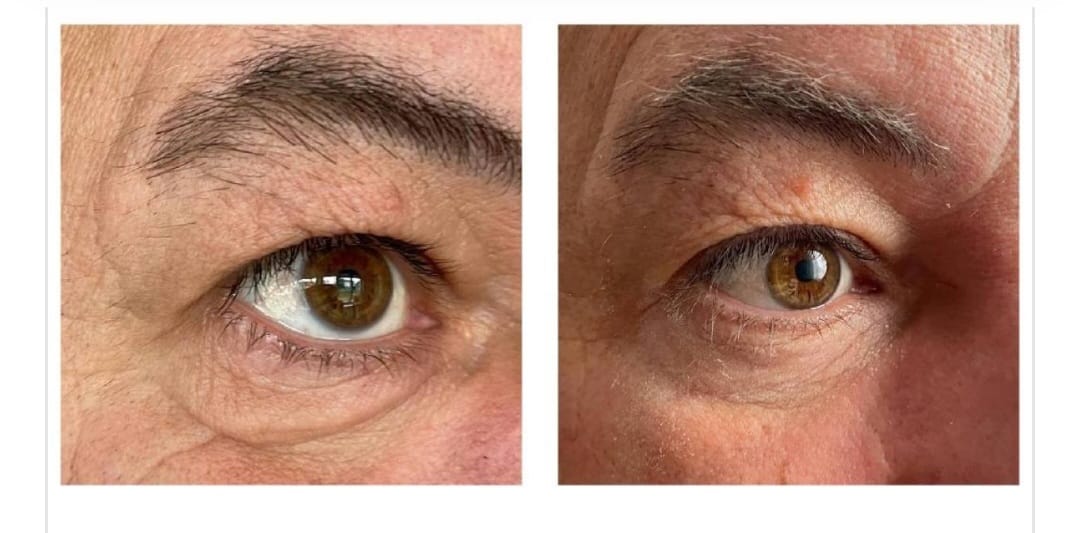 Peptilux - Anti-wrinkle eye cream with shock action effect with LIPHASYN™ - 20 ml